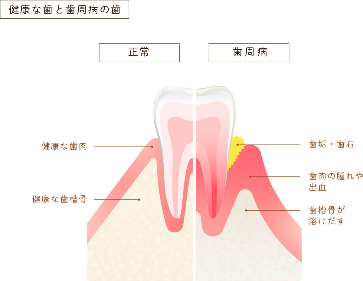 健康な歯と歯周病の歯